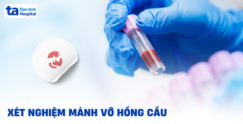 Xét nghiệm mảnh vỡ hồng cầu: Quy trình và tìm hiểu ý nghĩa kết quả