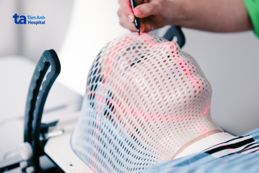 mặt nạ cố định giúp hạn chế ảnh hưởng của tia xạ lên mô lành