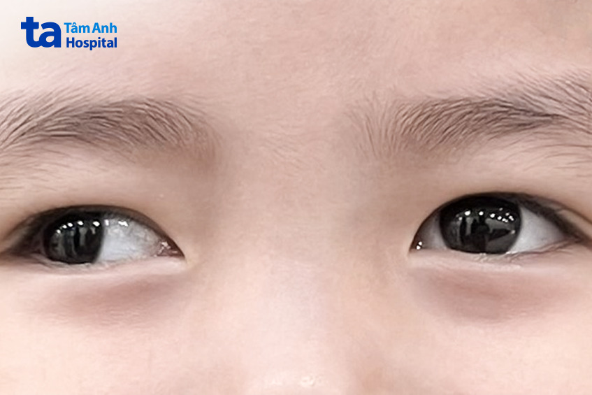 mắt phải của An bị lác nhiều hơn so với mắt trái