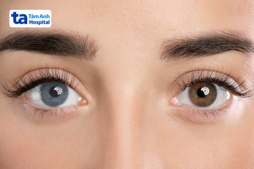 màu sắc mống mắt khác nhau