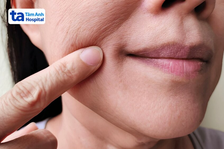 meso không kim chống chỉ định với ai