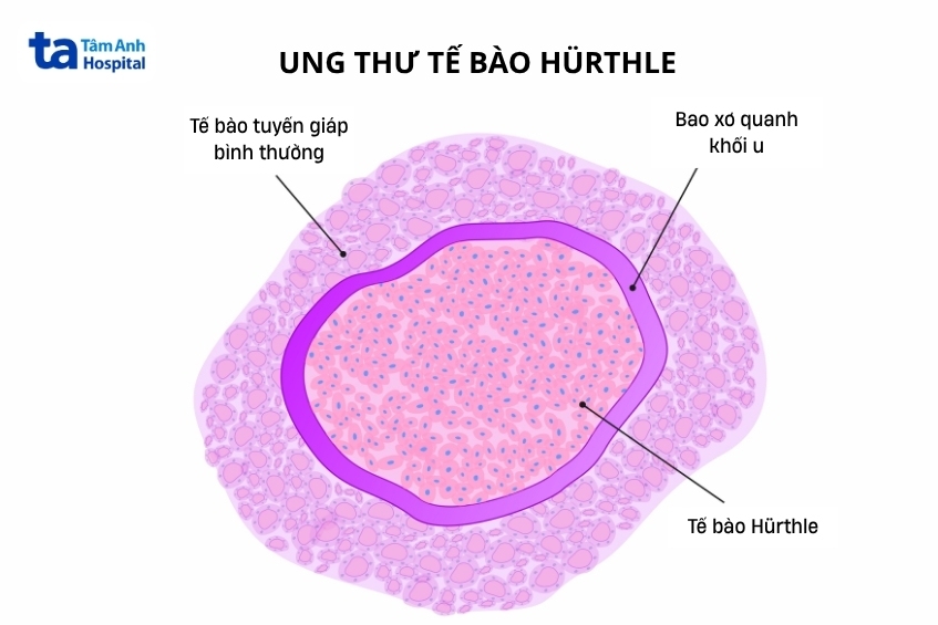 minh họa khối u ung thư tế bào ái toan