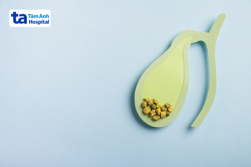 Mô hình túi mật chứa sỏi mật bằng giấy màu minh họa bệnh lý sỏi mật thường gặp