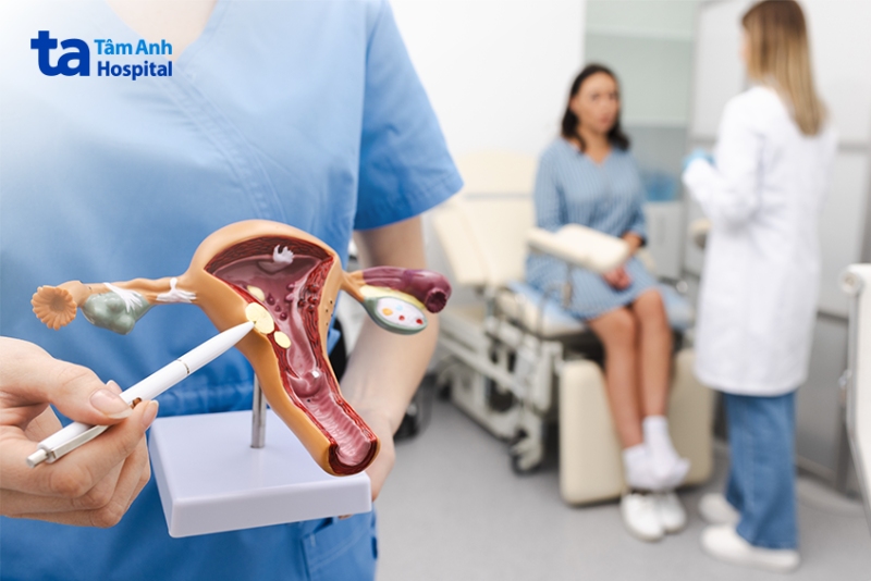 mô hình u bì buồng trứng