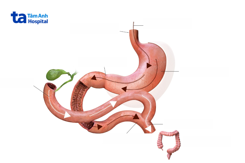 Mô phỏng cấu trúc nối mật ruột trong phẫu thuật điều trị tắc nghẽn đường mật
