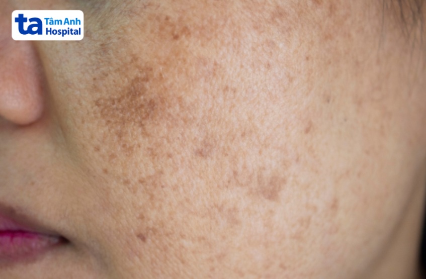 nám da khi mang thai có tự hết không