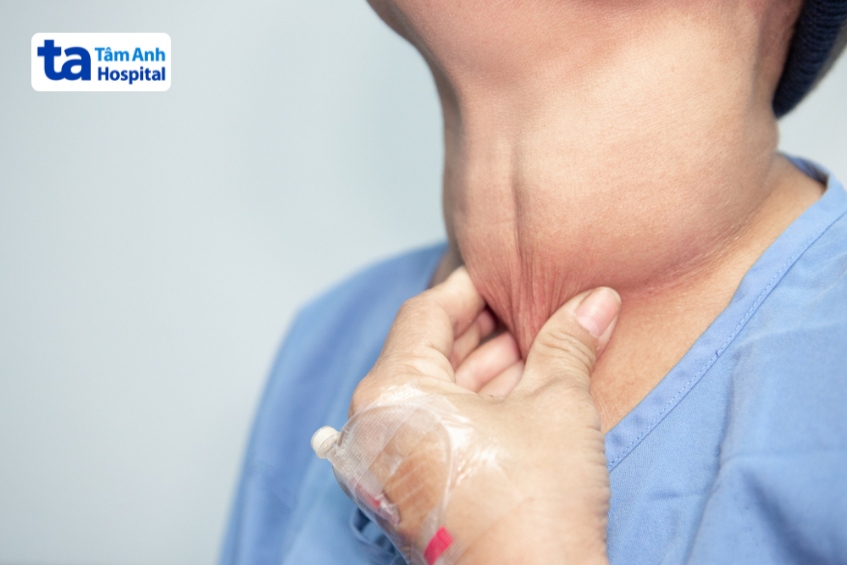 nang giáp xuất huyết nghiêm trọng có thể gây biến chứng cấp tính