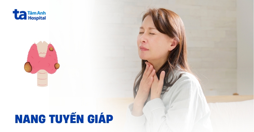 Tìm hiểu về nang tuyến giáp