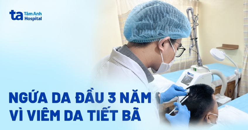 Ngứa da đầu 3 năm vì viêm da tiết bã