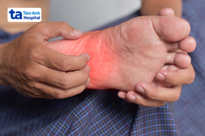 Ngứa Lòng Bàn Chân Cho Sốt Xuất Huyết
