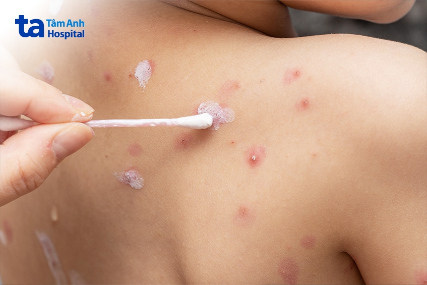 người bệnh cần bôi thuốc theo chỉ định của bác sĩ