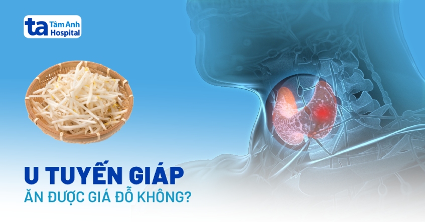 Người bệnh u tuyến giáp có ăn được giá đỗ không?