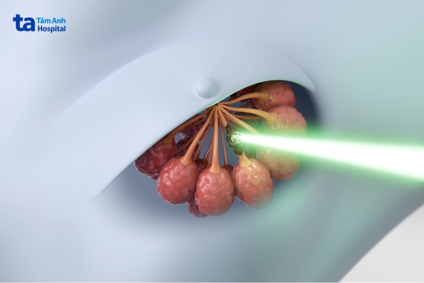 người bệnh ung thư vú trái được xạ trị bằng dibh nhằm giảm tối đa ảnh hưởng đến tim và phổi