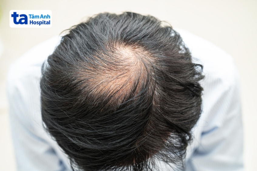 người bệnh xạ trị vùng đầu cổ có thể rụng tóc ở vùng da đầu được chiếu xạ