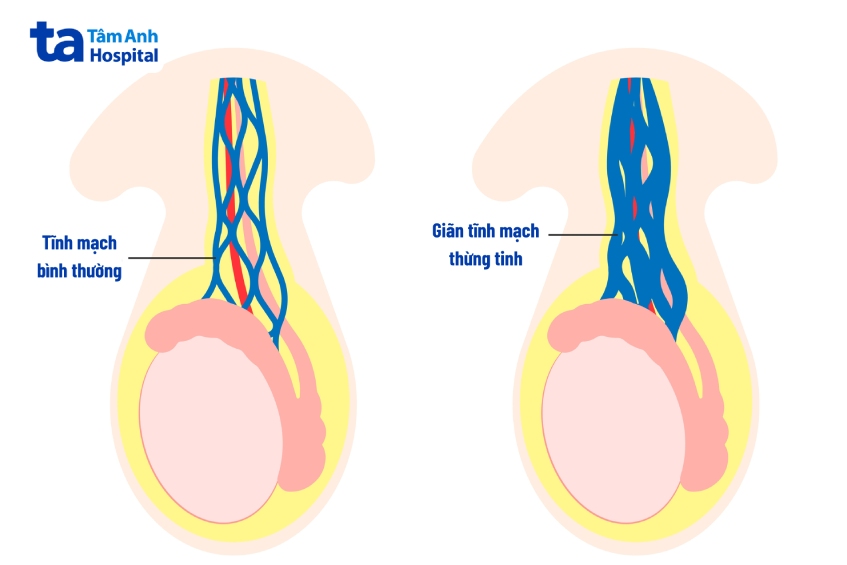 Người bị giãn tĩnh mạch thừng tinh thường có cảm giác đau và nặng bìu, thấy rõ sưng phía trên bìu