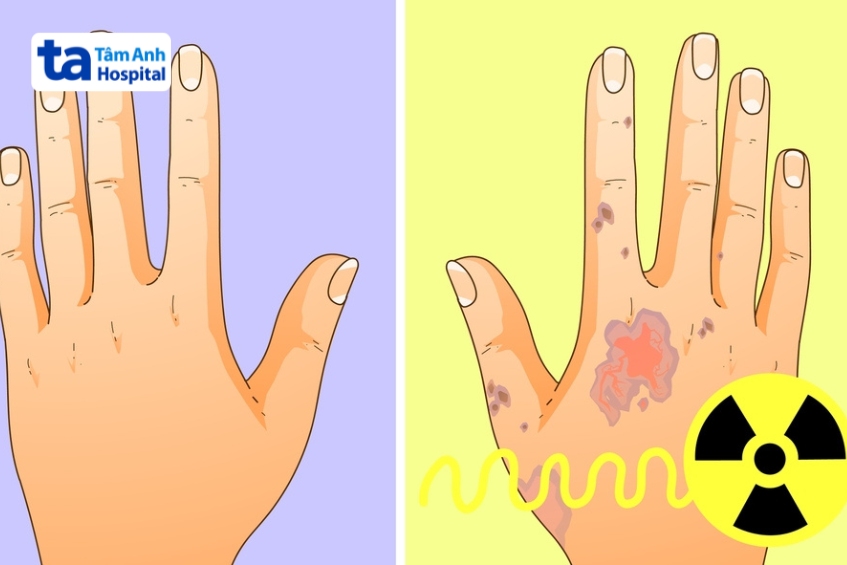 người bị phơi nhiễm phóng xạ có thể xuất hiện tình trạng đỏ rát, phồng rộp, bỏng xạ hoặc rụng tóc cục bộ tại khu vực tiếp xúc trực tiếp