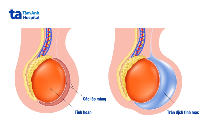 Người bị tràn dịch tinh mạc thường có cảm giác nặng bìu, kích thước bìu sưng to do ứ nước