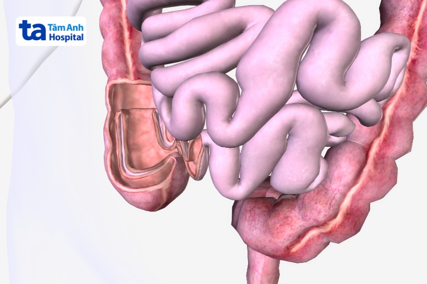người lớn bị lồng ruột