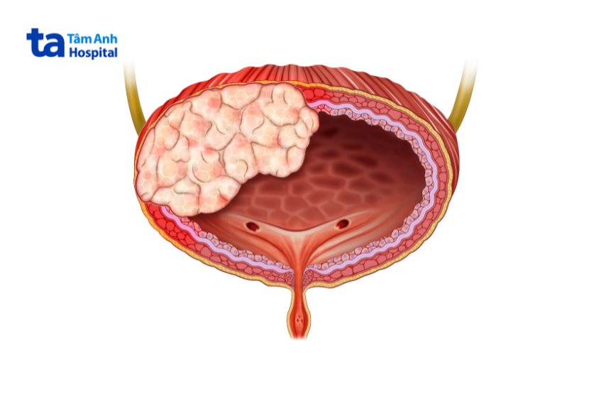 nguyên nhân gây rò bàng quang âm đạo