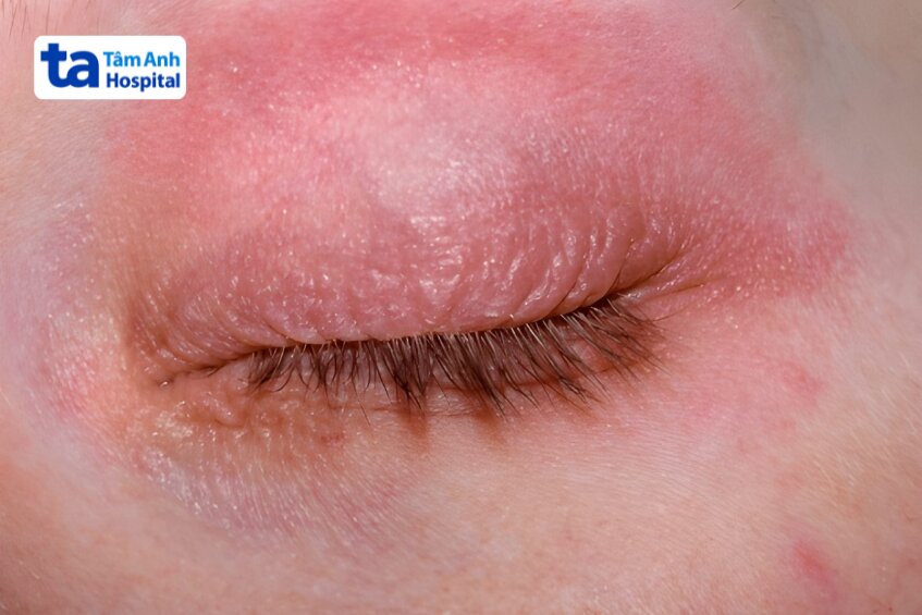 nguyên nhân gây viêm da tiếp xúc vùng mắt