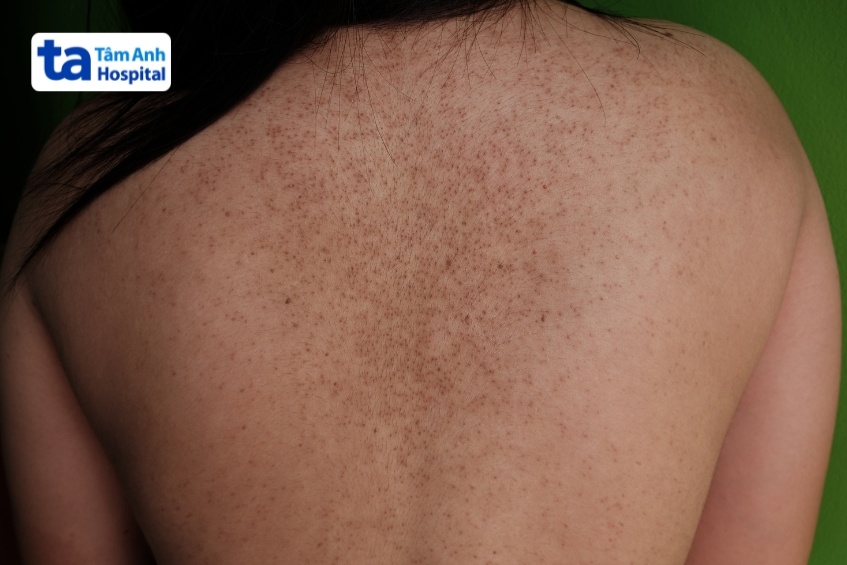 nguyên nhân lưng bị sạm đen