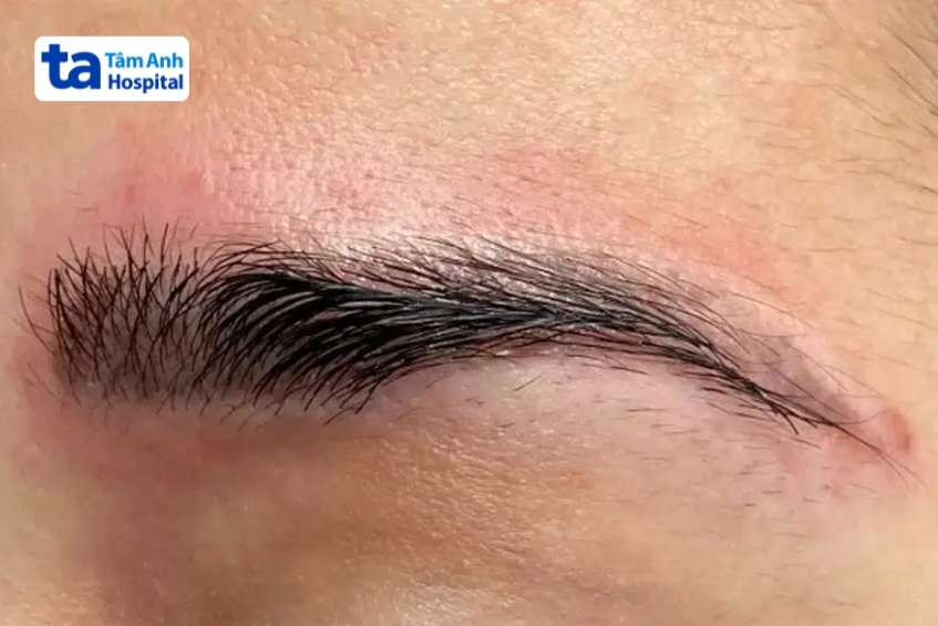 nguyên nhân rụng lông sau laser chân mày