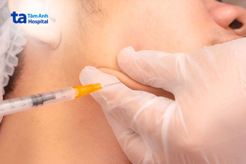 nguyên tắc kiêng cử sau tiêm tan filler