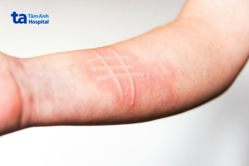 nhận biết da vẽ nổi