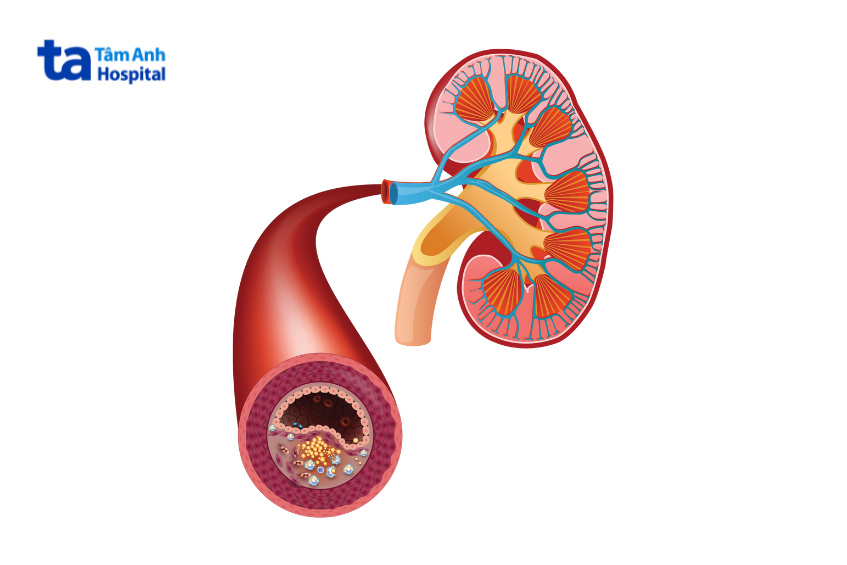 nhận biết huyết khối tĩnh mạch thận