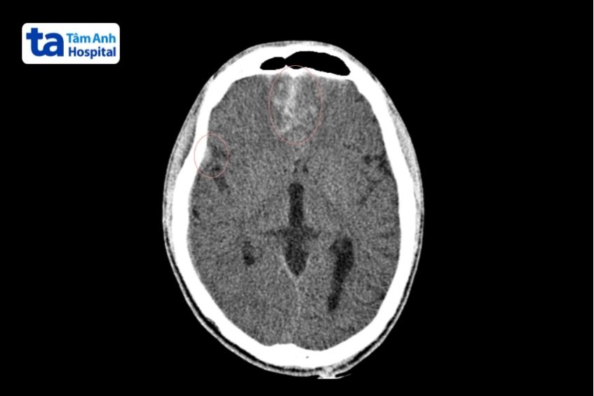 nhận diện xuất huyết khoang dưới nhện