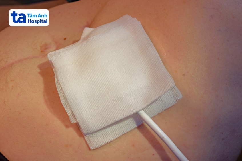 Nhiễm trùng tại vị trí đường ra của dây truyền động (driveline) là một trong những rủi ro có thể gặp phải khi cấy ghép VAD