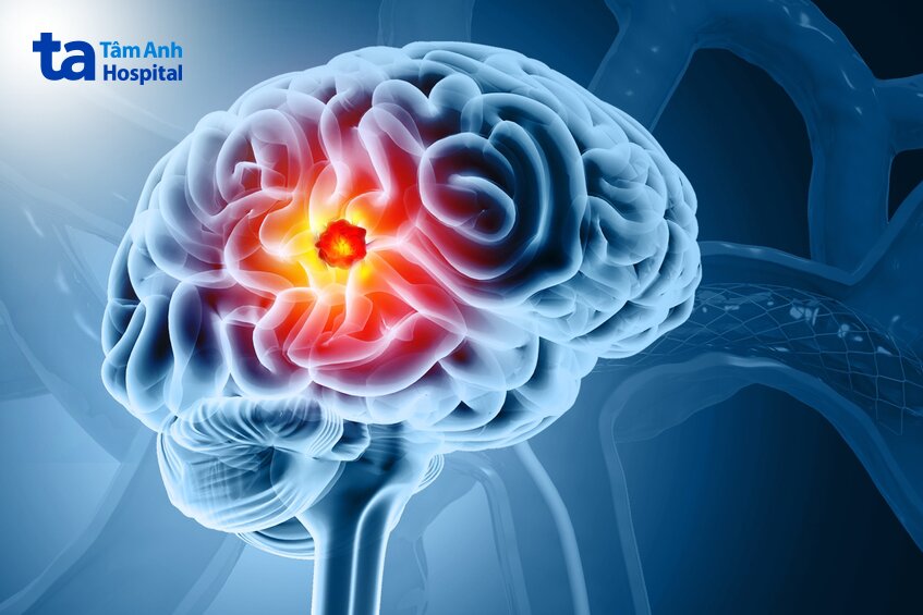 nhiều bệnh ung thư có thể di căn não