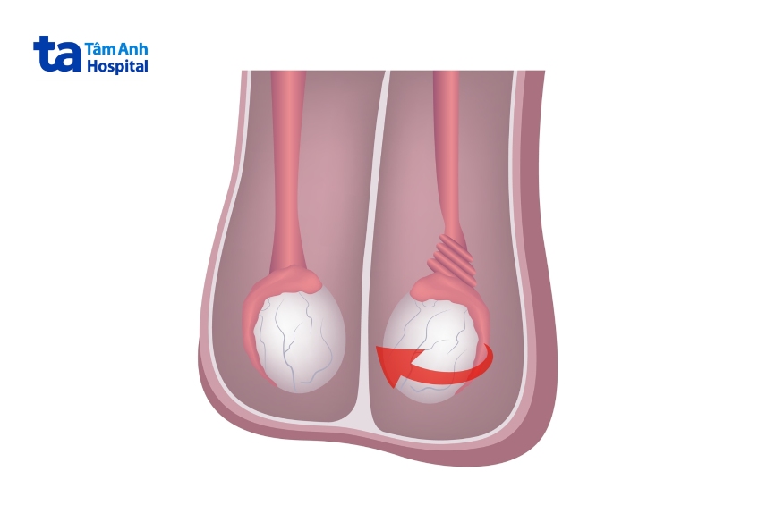 Nhiều trường hợp gặp chứng đau bìu cấp do liên quan xoắn tinh hoàn