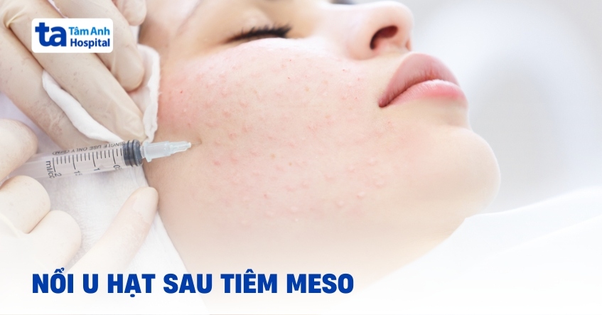 Nổi u hạt sau tiêm meso và cách điều trị