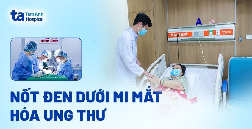 Nốt đen dưới mi mắt hóa ung thư