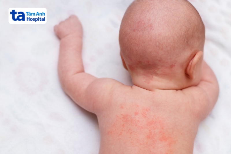 nốt sần nổi thành mảng