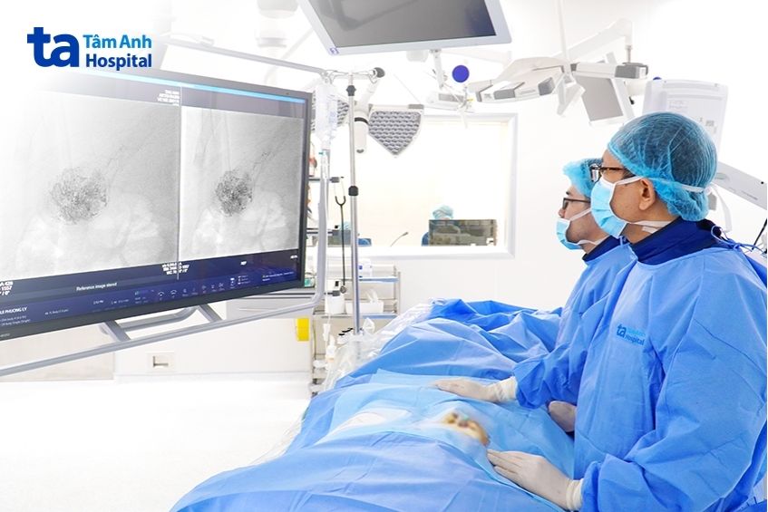 nút mạch khối u gan