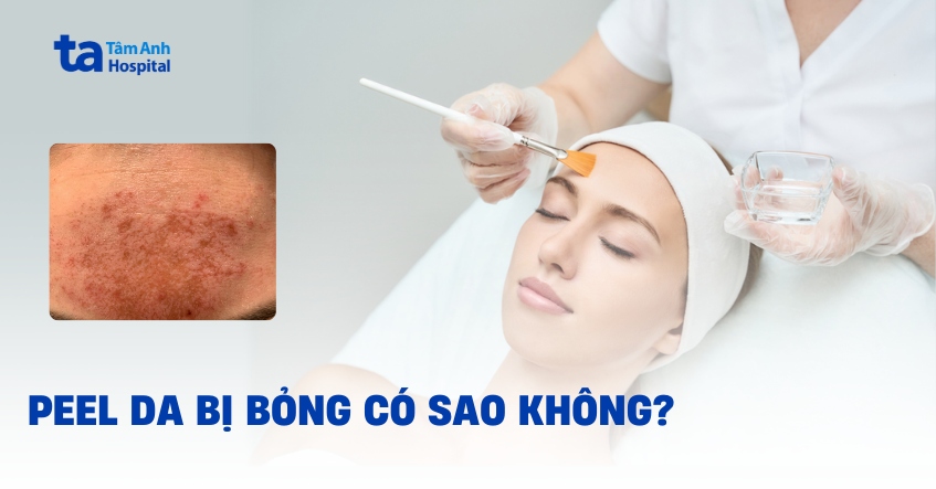 Peel da bị bỏng phải làm sao? Dấu hiệu nhận biết kèm hình ảnh