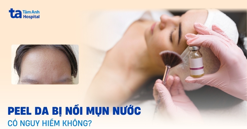 Vì sao peel da bị nổi mụn nước và cách xử trí an toàn