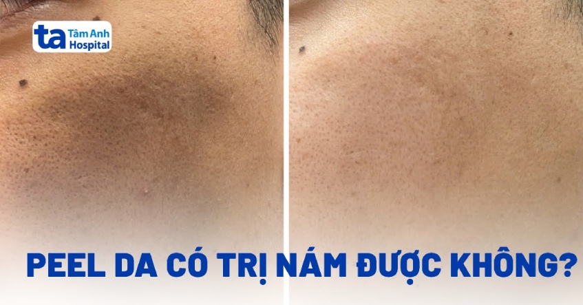 Sự thật về peel da trị nám có hết hoàn toàn không?