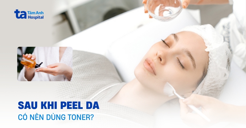 Bạn gái peel da xong có nên dùng toner để cấp ẩm?