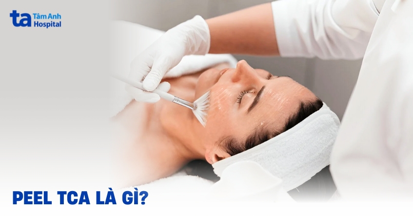 Peel TCA và những điều cần lưu ý khi lựa chọn