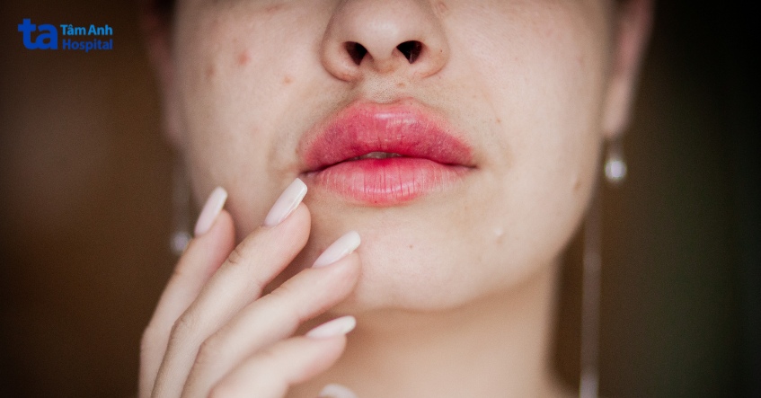 phá vỡ cấu trúc da khi tiêm tan filler không đúng kỹ thuật