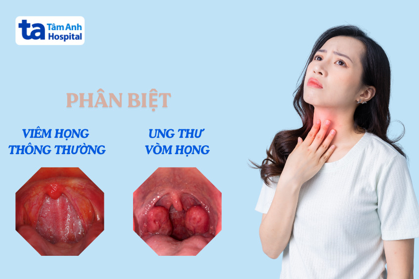 phân biệt viêm họng và ung thư vòm họng