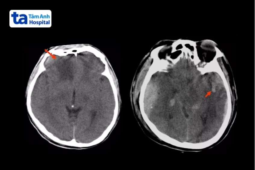 phát hiện dập não do chấn thương