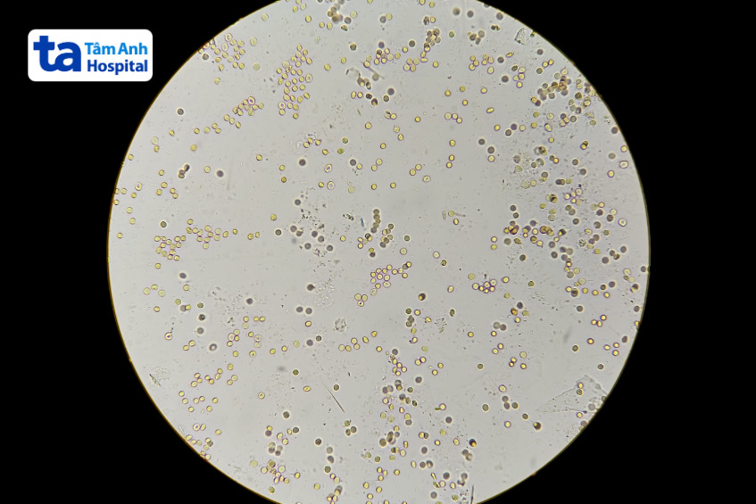 phát hiện hồng cầu trong nước tiểu qua kính hiển vi