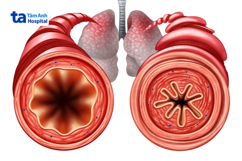 phế quản bình thường và bị viêm