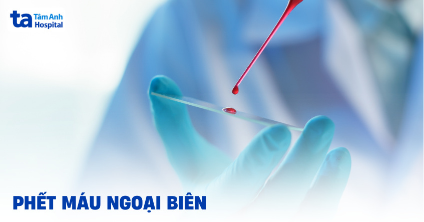 Xét nghiệm phết máu ngoại biên là gì? Chỉ định, quy trình?