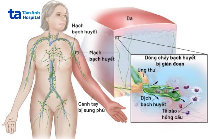 Phù bạch huyết là gì