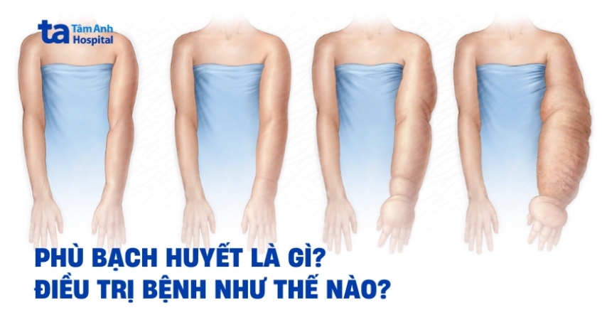 Phù bạch huyết là gì? Điều trị thế nào để phòng tiến triển nặng hơn?